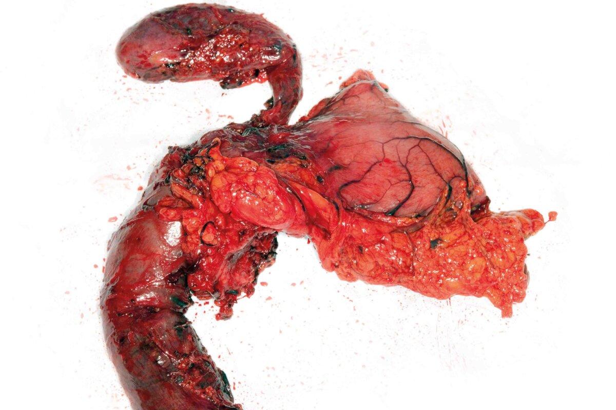 Pancreatic cancer,Whipple surgery. Tissue removed from a patient with pancreatic cancer. Whipple surgery involves the removal of the duodenum (the first part of the small intestine),part of the stomach,and the head of the pancreas. The jejunum (the next part of the small intestine) is then attached to the remains of the pancreas and stomach to bypass the removed tissue and organs