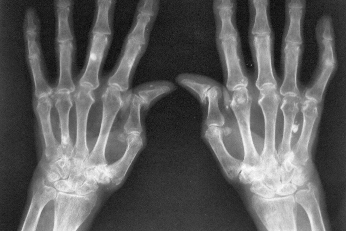 Strukturelle Schäden entwickeln Patienten mit rheumatoider Arthritis häufiger bei hohen Entzündungswerten und Autoantikörpern im Blut.
